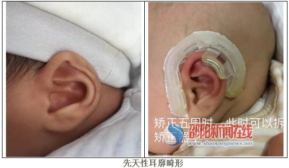 新生儿耳廓畸形不要慌，市中心医院专家来帮忙_邵阳头条网