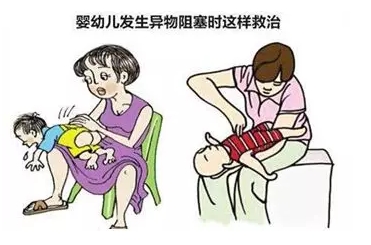 反复咳嗽发烧、呼吸窘迫，9个月幼儿肺内的“定时炸弹”竟然是……