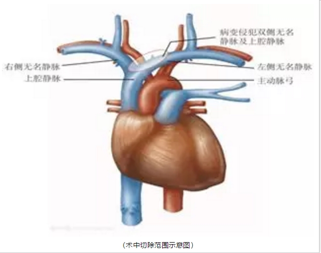 邵阳市中心医院：破拆重建，仁心仁术保心胸无恙