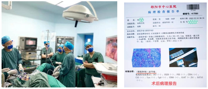 邵阳市中心医院泌尿外科完成一例罕见膀胱肿瘤切除术
