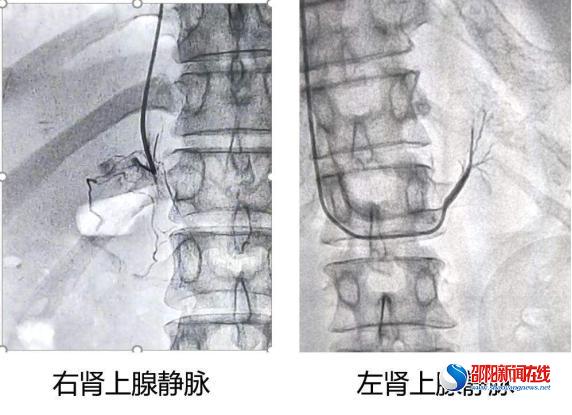 市中心医院成功开展湘西南地区首例肾上腺静脉采血