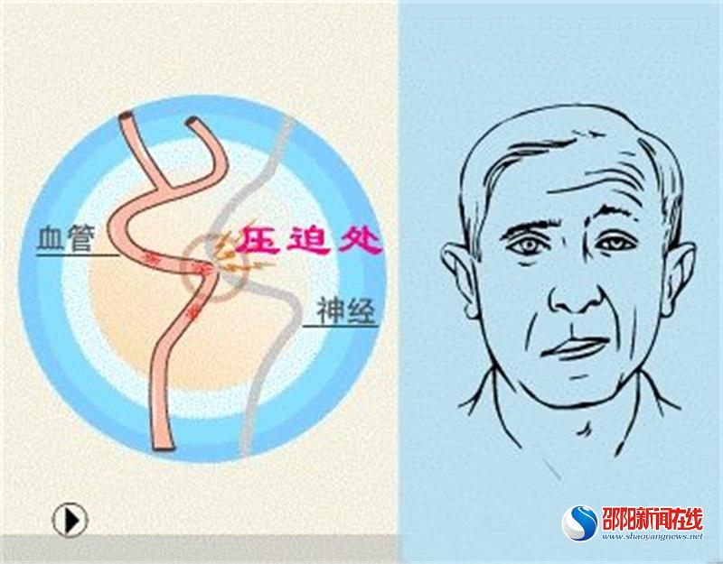 眼皮跳、口角抽、脖子歪怎么办？邵阳学院附属第一医院神经内科有法宝