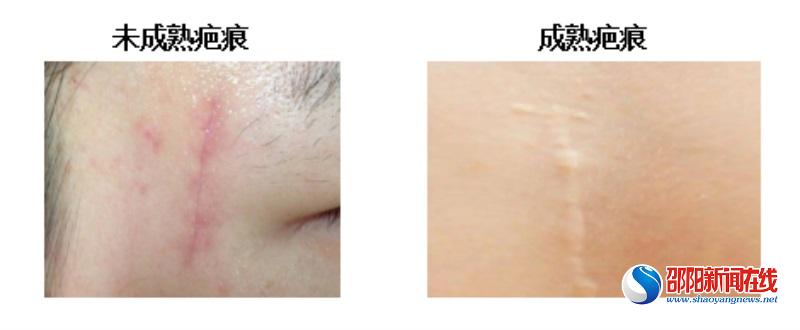 创伤后留下疤痕，早期该如何治疗？