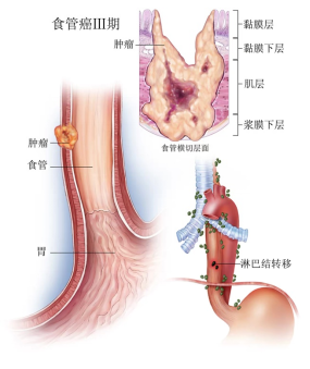 “瘘”网之“愈”——邵阳市中心医院心胸外科成功治愈一例复杂食管癌术后吻合口瘘患者