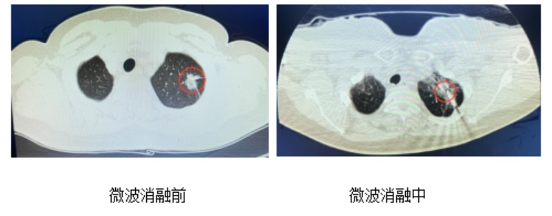 “小针头”，大作为——邵阳市中心医院心胸外科又成功完成一例局麻CT引导下经皮肺结节消融术