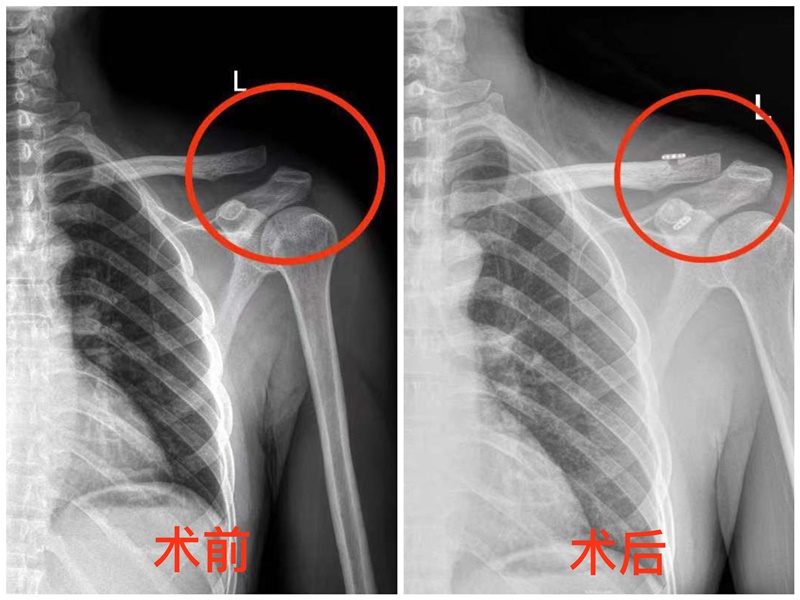 新宁县人民医院成功开展县内首例微创Endobutton袢钢板肩锁关节脱位治疗