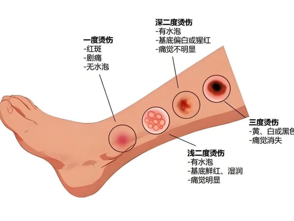 邵医科普丨低温烫伤，温柔的“隐形杀手”