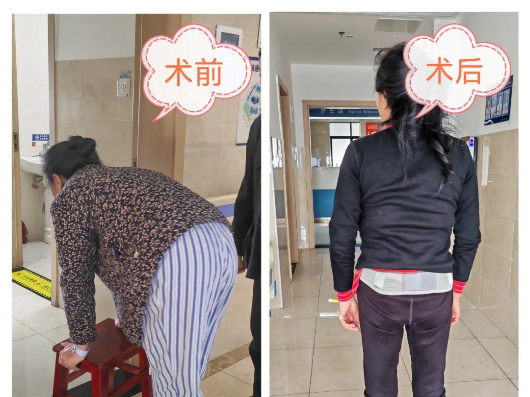新宁县人民医院：切口仅7毫米！椎间盘孔镜手术-小孔解决大烦恼