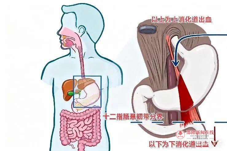生死时速——邵阳市中心医院多学科协作挽救失血的生命