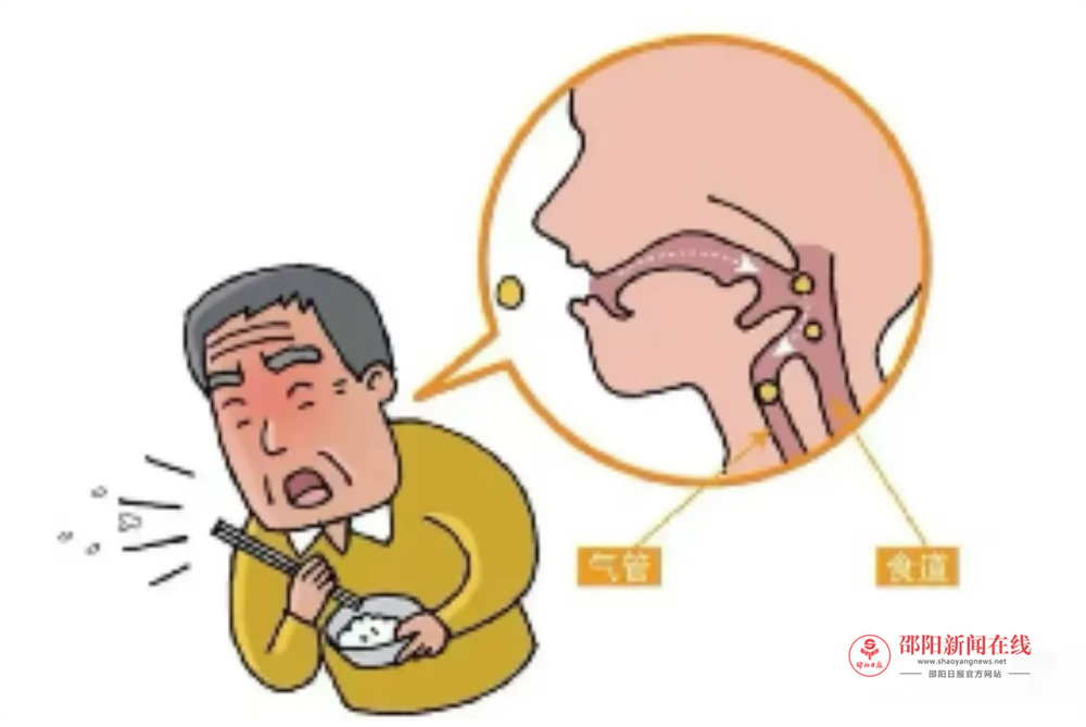 新宁县人民医院：50岁大叔脑梗死靠鼻饲，康复吞咽球囊扩张术重享美好人生